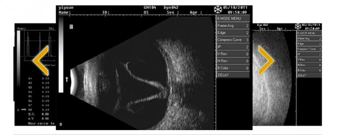 ODU8 ophthalmonic  A/B ultrasound scanner