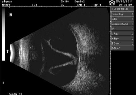 ODU8 Ophthalmic A/B Ultrasound Scanner